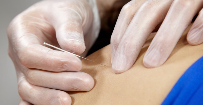 services/terapia-dry-needling.jpg